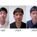 40대 남성 무쌍눈매교정, 코수술 이미지