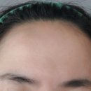 일치성형외과의원 | 보톡스 시술 후 1주차 후기(광주 아티스 성형외과)