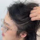대구두피문신(SMP)로아르스칼프 찐막 후기!!!