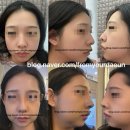 보인당약국 | 가짜코 프로젝트 | 기능미용코수술후기 | 수술 다음날 ~7일차 | 수술전후사진