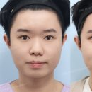 바이브성형외과의원 | 찾아온 남자 코성형, 귀여운 이미지를 넘어 세련미를 완성하다 ! by 신논현역 바이브 성형외과 유영문 원장