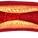 고지혈증의 이해와 관리 이미지