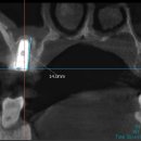 함양안과의원 | 곡성치과, 병원 3곳 거쳐 찾아낸 어금니 통증 원인
