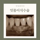 수원치과 잇몸이식수술 패인잇몸 잇몸 내려앉음 수술후기