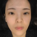 강남역 올피채의원&lt;강력한 미백관리 피코슈어토닝후기&gt;강남 레이저 리프팅/울쎄라/튠페이스/인모드바...