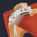 진잠한의원 | [혜민서한의원] 석회화건염