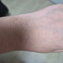 새움3로(서) | [일상] 척골 충돌 증후군, TFCC 수술 기록