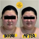 골근위수영뷰티아카데미학원 | 위뷰티교대점 얼굴윤곽 <턱쉐딩피부관리> 자기개발 후기! 전후사진, 효과