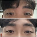 오오피부과의원 | 부산서면피부과 코필러 솔직후기 및 가격