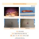 만성담낭염수술후기. 입원기간, 수술 후 상처 크기, 회복시간이 빠르다고 하여 선택하게 되었다. 이미지