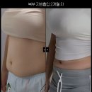 뱃살 걱정 이젠 끝! 압구정 지방흡입 일공공성형외과 복부 지방흡입 리얼 후기