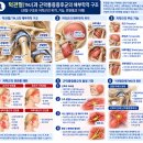 턱관절(TMJ)과 근막통증증후군 씹는 근육의 트리거포인트와 연관통. 이미지