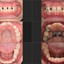 나란이치과의원 | [인천구월동교정전문치과] 서울나란이치과 - 페이스마스크교정후기