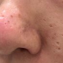 하나트랜스 | 수원여드름흉터 트랜스테라피 새살침 2회차 솔직후기