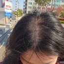 구월동 SMP STUDIO 고함량 엑소좀 탈모관리 3회차후기