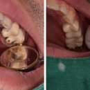 장수 치과기공소 | when your patient is a dentist. 치과 신경치료 통증, MTA신경치료로 안되면 신경관 다 찾기