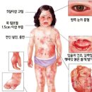 가와사키병 원인 증상 치료 아기 발진 고열 이미지