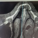 더웰이비인후과의원 | 이비인후과 일요일진료 코골절진단 진료의뢰서 아이뒷통수가격 당해 코골절 호매실연세이비인후과 진료후기