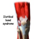 **I.T.B PAIN SYNDROME** 이미지
