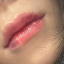 부평 톤즈의원 인천 본점 입술 필러 + 입꼬리 보톡스 후기