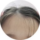 성치과의원 | 성조숙증 주사 1년 후기(초등3학년)