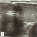 갑상선암의 초음파 소견 이미지