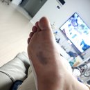 연세보조기 | 우측 제5중족골 기저부 골절_수술 후기 2 (추천템, 보조기, 재택근무)