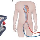 에크모(ECMO)를 아시나요...? 이미지