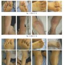 송미사 - 제주시 한수풀로 142 | [족부 백선] 무좀, 어떻게 치료할까요?
