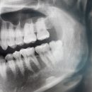 OK치과의원 | 사랑니 발치 치과 추천, 사랑이 아프니 강남점 매복 사랑니 발치 통증 붓기 후기