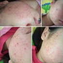 리유한의원 강남본점 박해웅원장님께 받은 안면 지루피부염 치료 후기