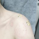 은정형외과의원 | 어깨 동결건 석회건염 정형외과의원 체외충격파 주사 치료 솔직후기