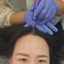 두피킹 - 수성구 신매동 | 대구 북구 동천동 두피관리 새로나다모발킹 두피생장술 후기