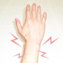 [손목터널증후군증상/관절내시경수술] 손목터널증후군증상도 관절내시경수술로 치료한다 -부천연세사랑병원- 이미지