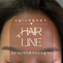 여자헤어라인모발이식_수술14개월 내돈내산후기