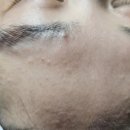 케이속건조피부연구소 | 구월동 좁쌀 케이속건조피부연구소 관리 솔직후기