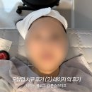 민중약국 | 모낭염 치료 과정 여드름 골드 PTT PDT 레이저 후기