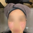 [강남] 공장형 리쥬란 2cc 신경 주사 통증 및 엠보 후기 + 크라이오셀