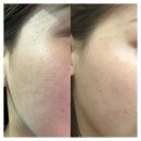 참온한의원 | 이마 편평사마귀 제거 후기 이후 관리할 사항!