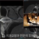 피어나의원 - 천안시 서북구 성성8로 2-7 | 검단 원당동 성장기 교정 | 코를 향해 누워있던 매복 송곳니, 발치하지 않고 살린 10세 여자아이 치료