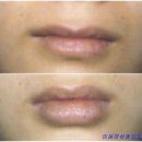 입술확대성형수술 - 얇은입술 이미지