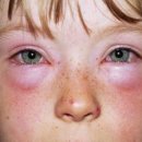 알레르기 이미지