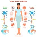 동양재활보조기 | 서강병원 물리치료: 다발성경화증(Multiple Sclerosis)