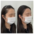 헤어 1979 | 오산 헤어라인 문신 후기, 얼굴형 고민 해결