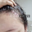 뉴스킨 갈바닉으로 두피케어하는 법 두피 뾰루지 박멸