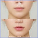 반월당입술필러 유지기간은 6개월? 1년? 진실은 이미지