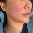 자연산한의원 | 부산 서면 한의원에서 튠페이스 이중턱 리프팅 내돈내산 솔직후기