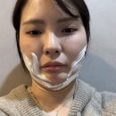 더웨이성형외과의원 | 강남역 소개팅주사 내돈내산 광소주사 이중턱 옆광대 솔직후기 전후사진