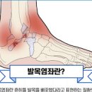 발목인대 늘어났을때 증상과 치료법 이미지