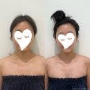 대광주유소 | 광주 피부관리 예신관리 이플에스테틱 하이퍼소닉 윤곽관리 받은 후기